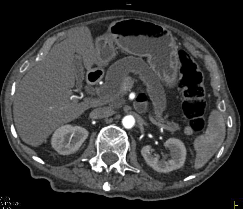 Central Intraductal Papillary Mucinous Neoplasm (IPMN) with High Grade Dysplasia - CTisus CT Scan