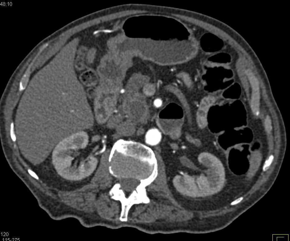 Central Intraductal Papillary Mucinous Neoplasm (IPMN) with High Grade Dysplasia - CTisus CT Scan