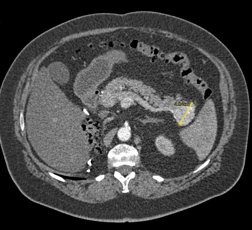 Vascular Metastases to the Pancreas from Renal Cell Carcinoma - CTisus CT Scan