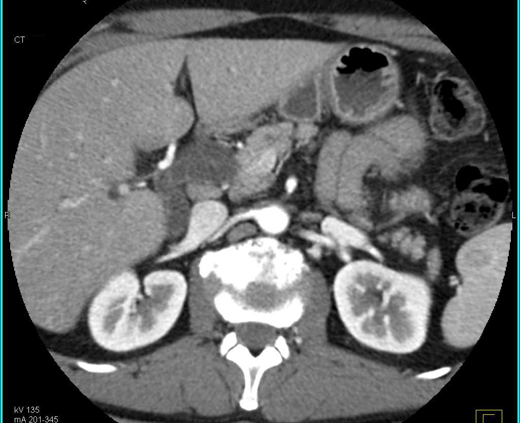 Cystic Neuroendocrine Tumor Pancreas with Enhancing Lesion - CTisus CT Scan