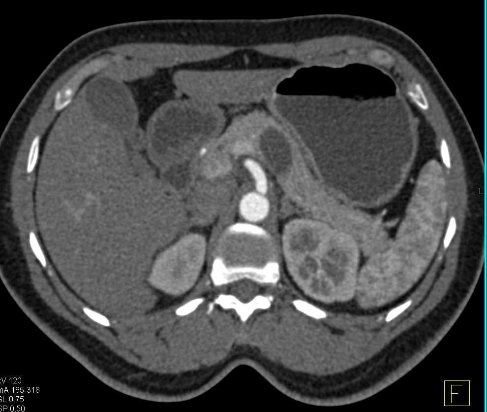 Intraductal Papillary Mucinous Neoplasm (IPMN) Body of the Pancreas - CTisus CT Scan