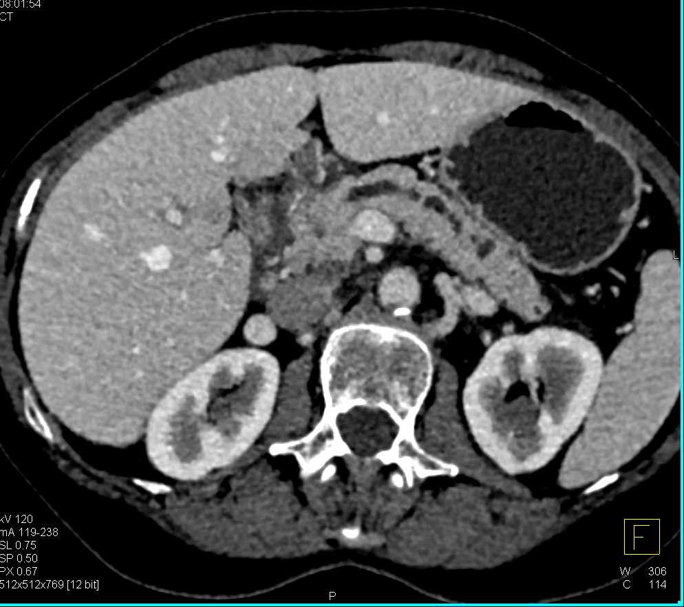 Subtle Carcinoma Head of Pancreas with Dilated Pancreatic Duct - CTisus CT Scan