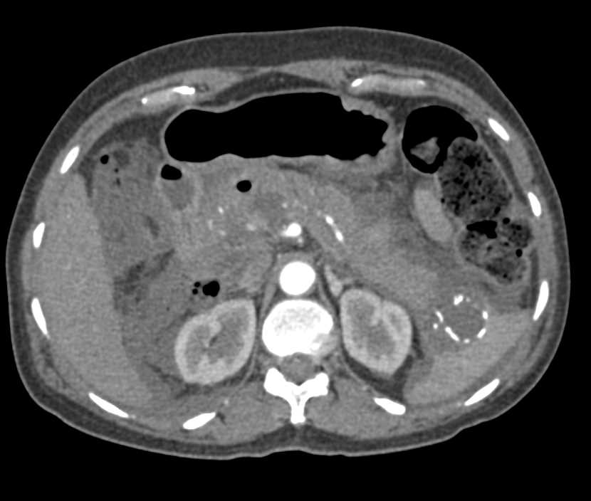 Perforated Duodenum s/p Endoscopic Retrograde Cholangiopancreatography (ERCP) with Acute and Chronic Pancreatitis - CTisus CT Scan