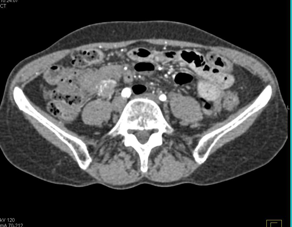 Ampullary Cancer with Liver Metastases - CTisus CT Scan