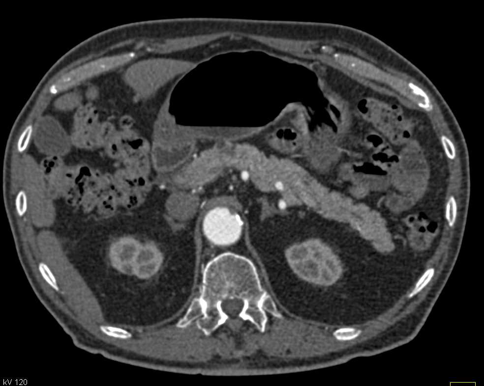 Multiple Small Intraductal Papillary Mucinous Neoplasms (IPMNs) and Mildly Dilated Pancreatic Duct - CTisus CT Scan