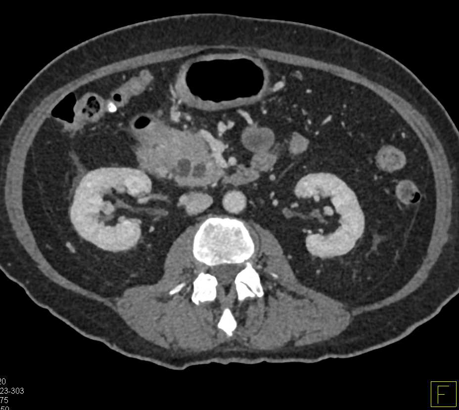 Ampullary Carcinoma with the Double Duct Sign - CTisus CT Scan