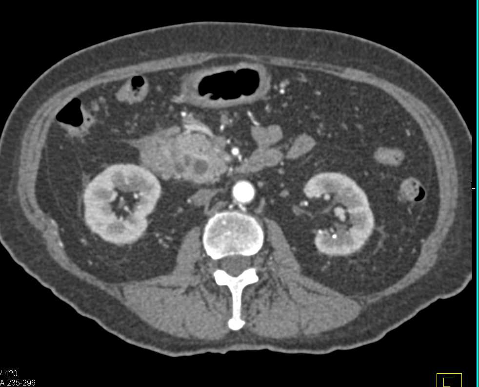 Ampullary Carcinoma with the Double Duct Sign - CTisus CT Scan