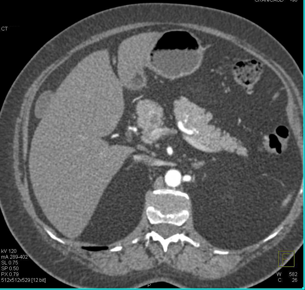 Cystic Neuroendocrine Tumor in the Head of the Pancreas - CTisus CT Scan