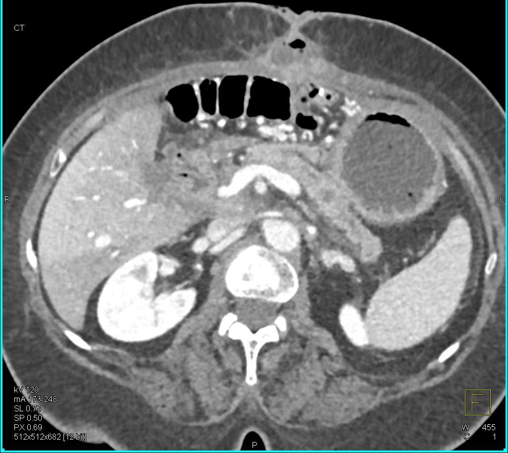 Abscess Abdominal Wall s/p Whipple Procedure - CTisus CT Scan