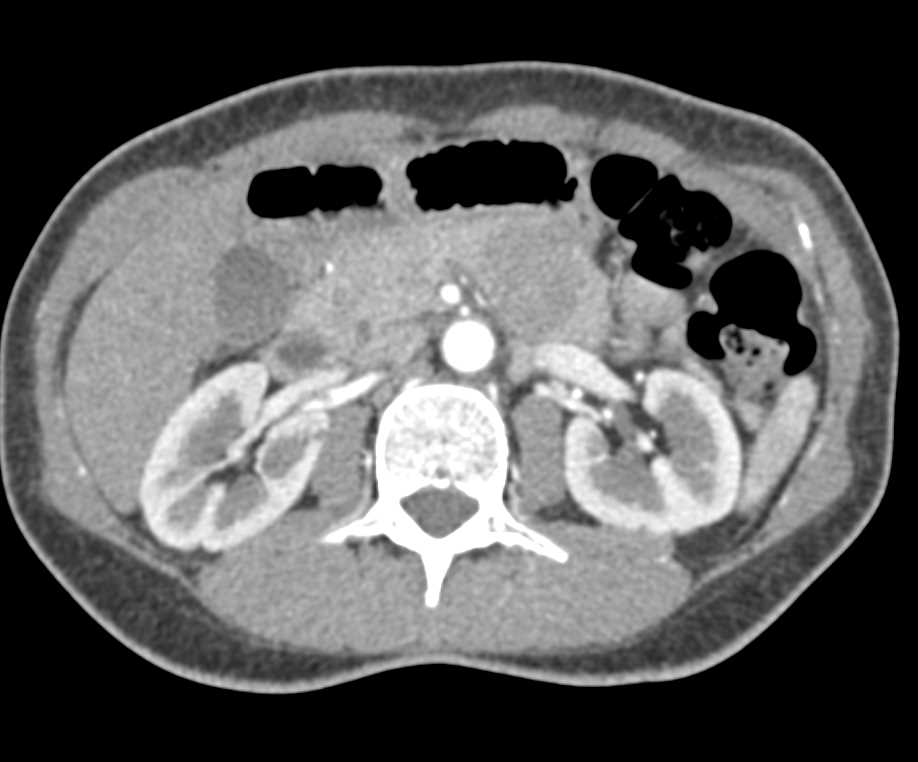 SPEN Tumor Tail of Pancreas - CTisus CT Scan