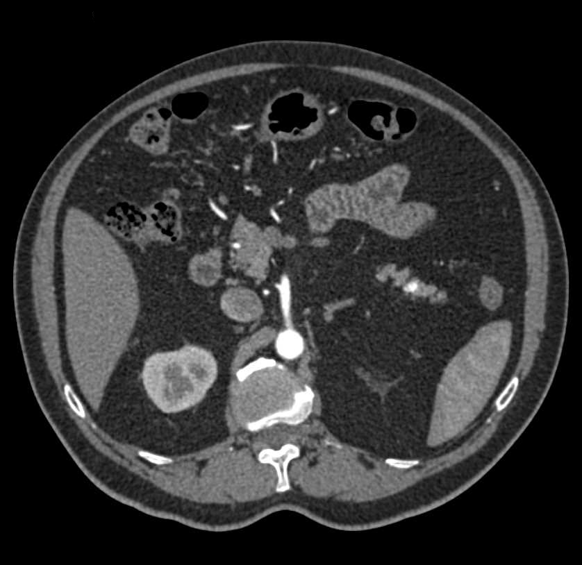 Vascular Map Around the Pancreas - CTisus CT Scan