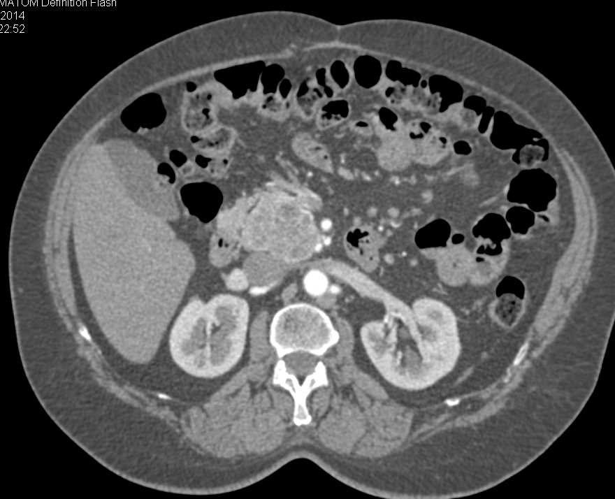 Neuroendocrine Tumor Near the Head of the Pancreas - CTisus CT Scan