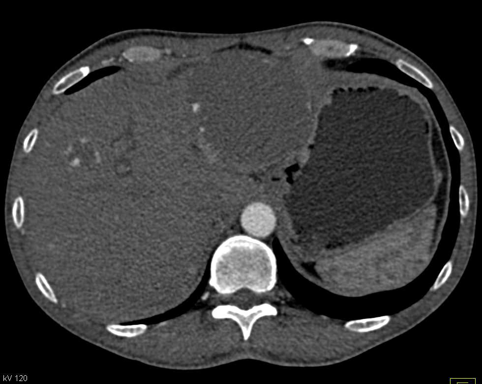 Neuroendocrine Tumor of the Pancreas with Liver Metastases and Hepatic Hemangiomas - CTisus CT Scan