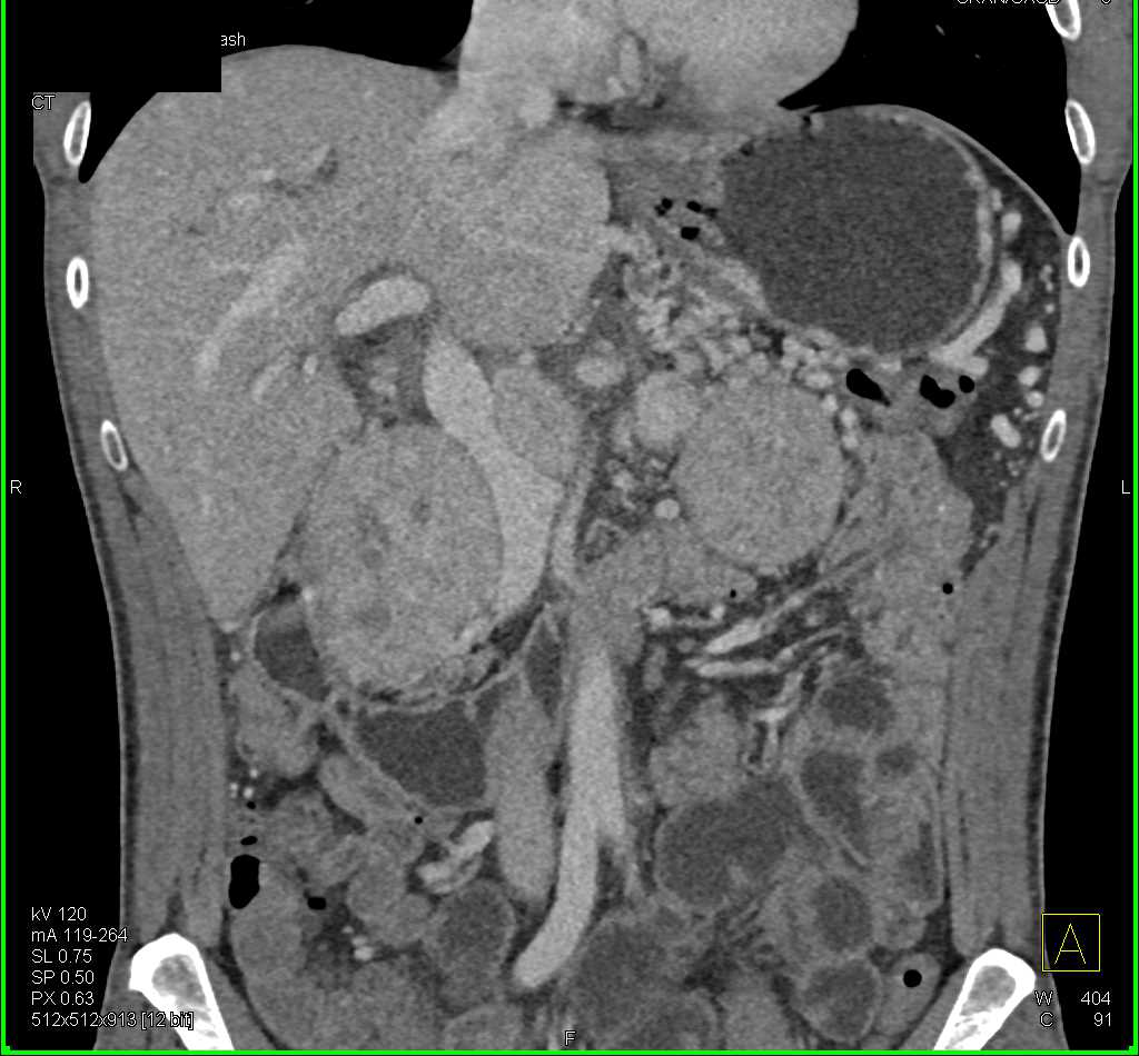 Neuroendocrine Tumor Of The Pancreas With Liver Metastases And Hepatic