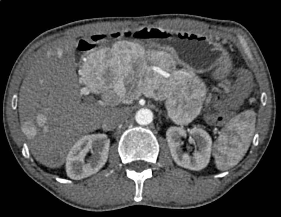 Neuroendocrine Tumor of the Pancreas with Liver Metastases - CTisus CT Scan