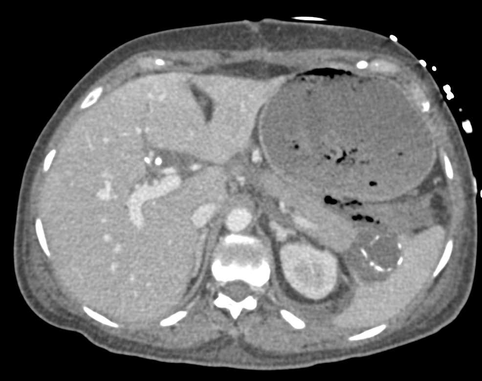 Active Bleed Seen Near Head of the Pancreas - CTisus CT Scan