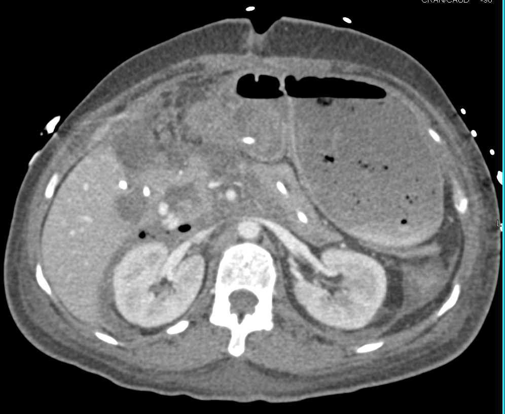 Active Bleed Seen Near Head of the Pancreas Seen Nicely on 3D Images - CTisus CT Scan