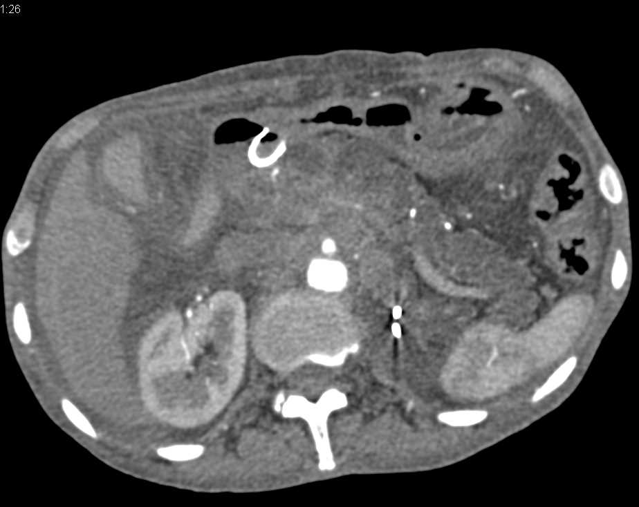 Acute and Chronic Pancreatitis with Infarct Right Kidney - CTisus CT Scan