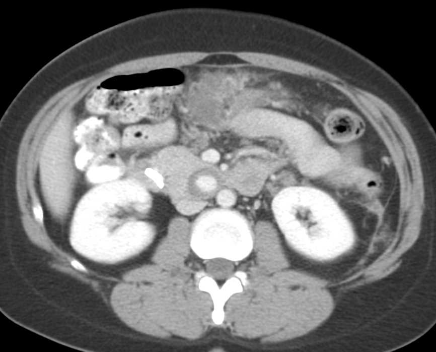 Pseudo-Aneurysm Near the Head of the Pancreas - CTisus CT Scan