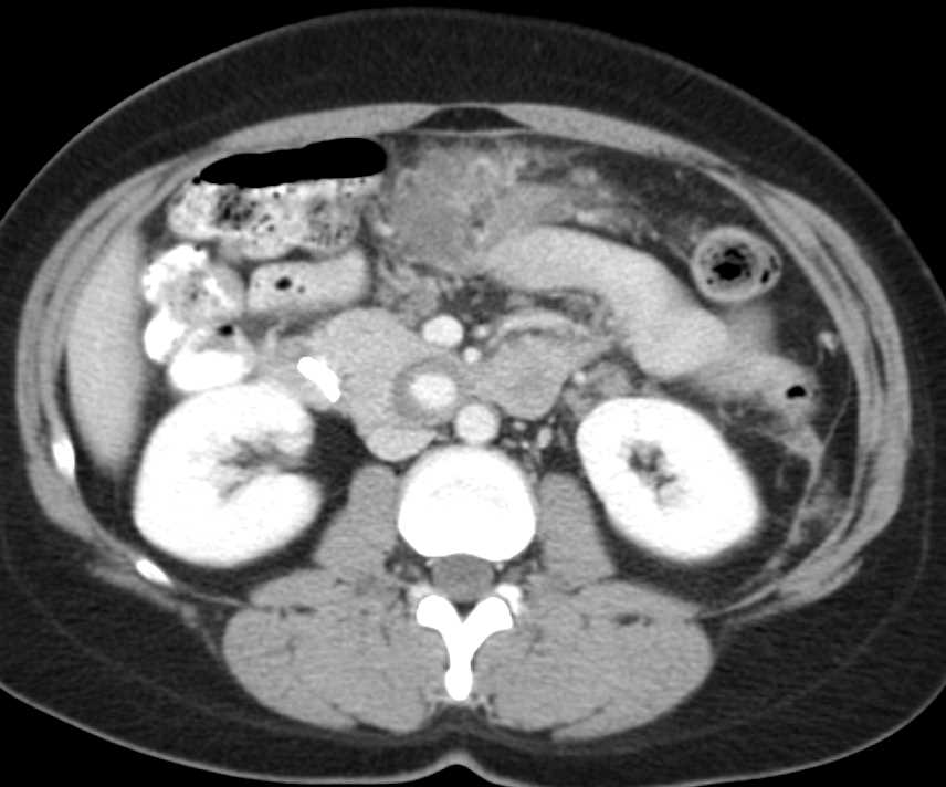 Pseudoaneurysm Near the Head of the Pancreas - CTisus CT Scan