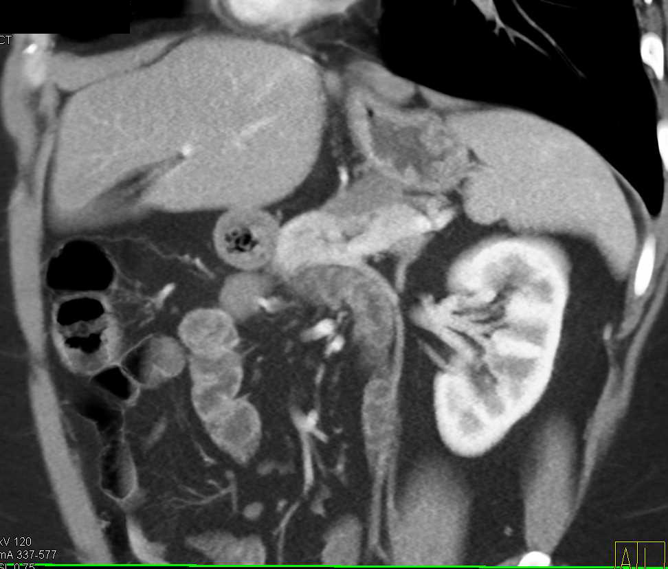 Lymphoepithelial Cyst Pancreas - CTisus CT Scan