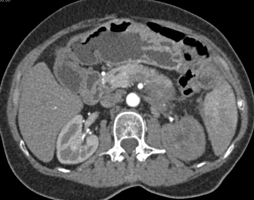 Carcinoma Tail of the Pancreas with Local Spread - CTisus CT Scan