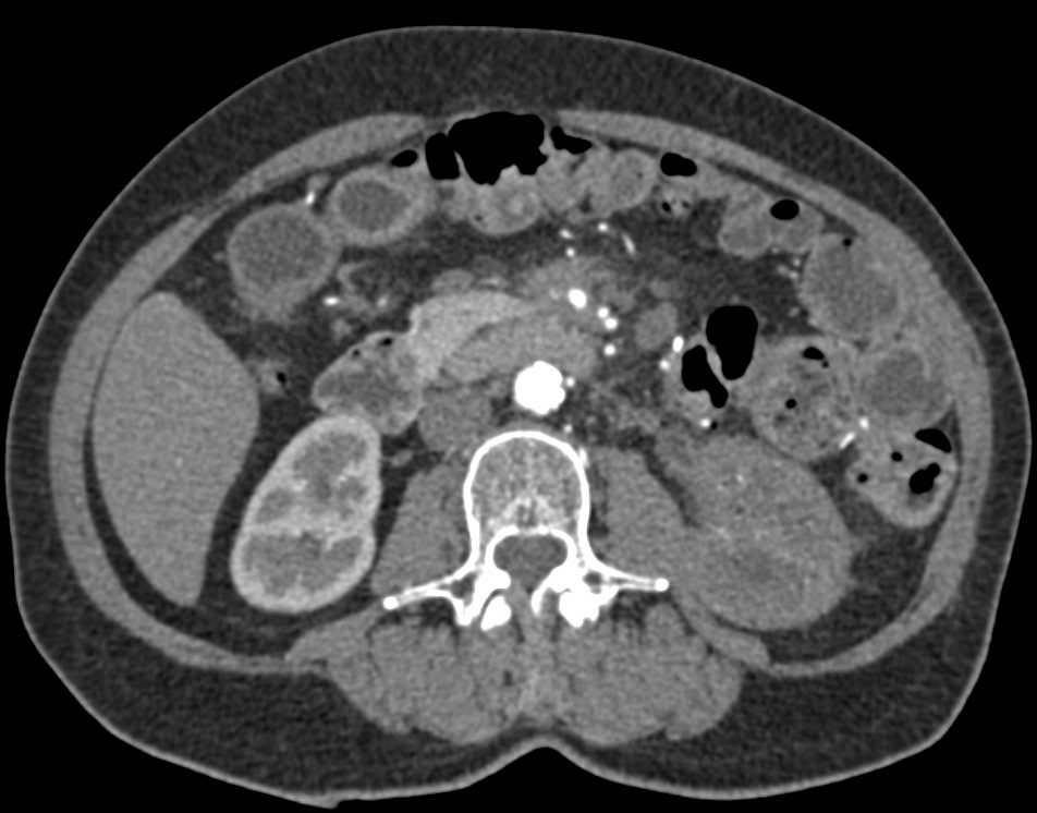 Pancreatic Cancer with Superior Mesenteric Artery (SMA) Encasement - CTisus CT Scan