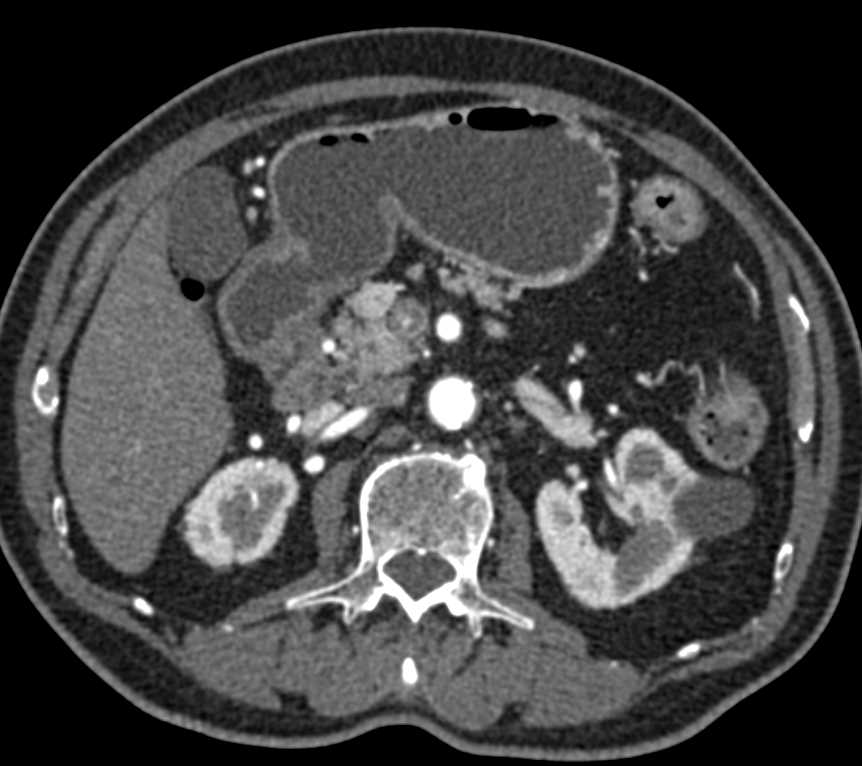 1 cm Neuroendocrine Tumor in the Head of the Pancreas - CTisus CT Scan