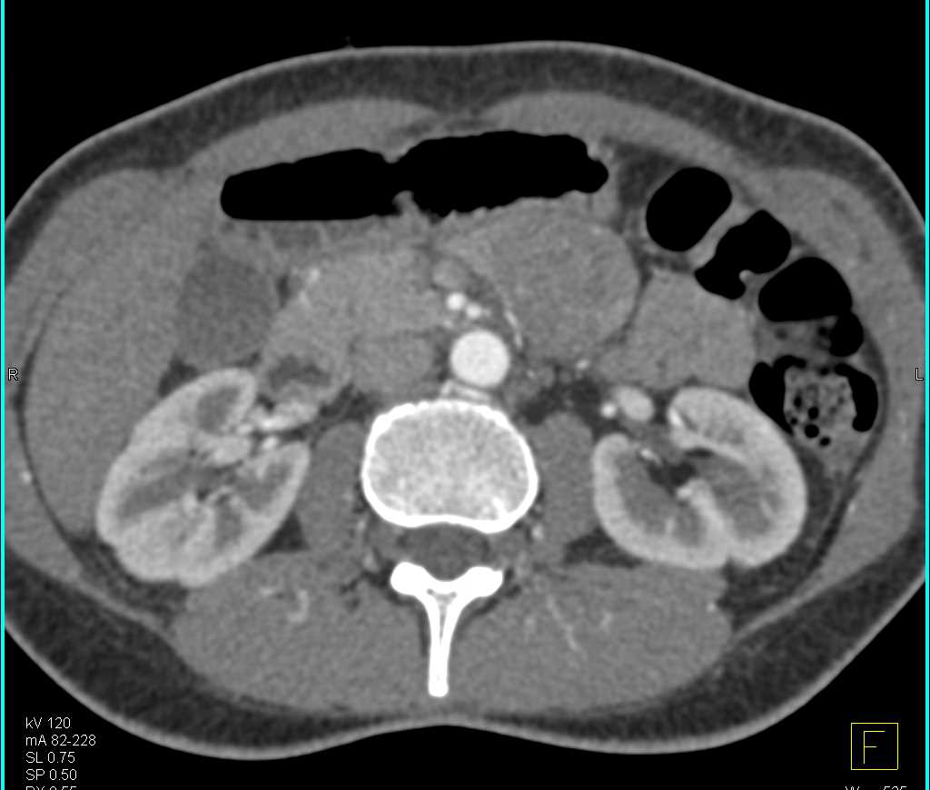 SPEN Tumor Pancreas (Solid and Papillary Epithelial Neoplasm) - CTisus CT Scan