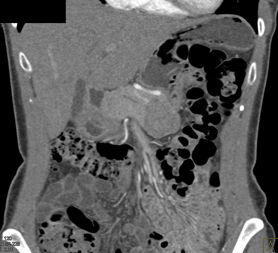 SPEN Tumor Pancreas (Solid and Papillary Epithelial Neoplasm) - CTisus CT Scan