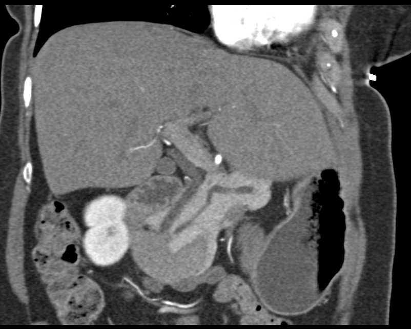 Central Intraductal Papillary Mucinous Neoplasm (IPMN) - CTisus CT Scan