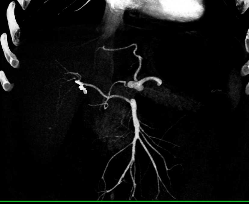 Ampullary Carcinoma - CTisus CT Scan