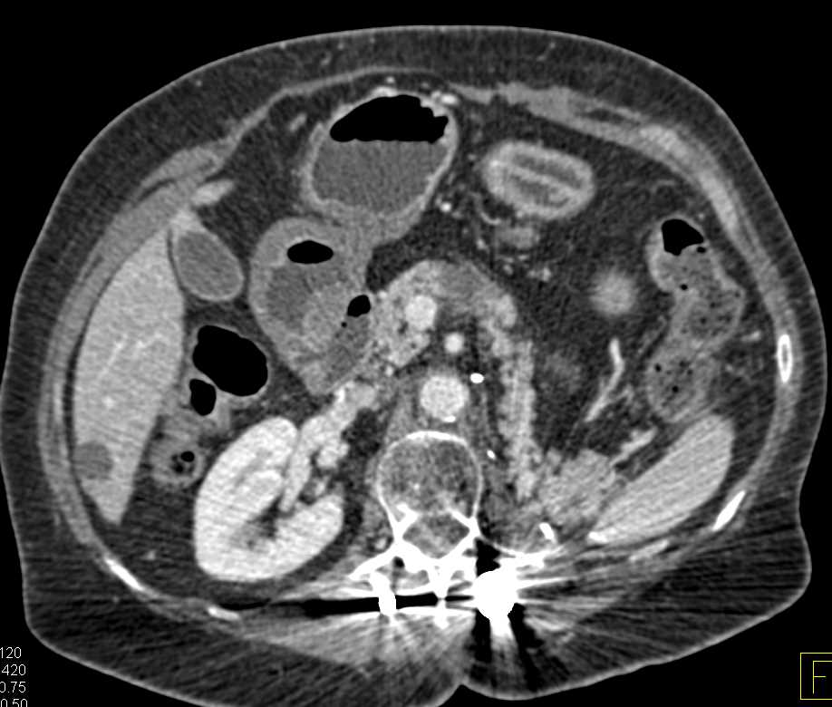 Subtle Carcinoma of the Body of the Pancreas - CTisus CT Scan