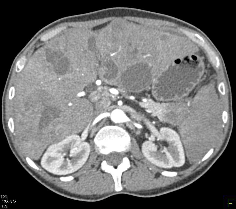 Carcinoma Tail of Pancreas Invades the Spleen with Infarction and Liver Metastases - CTisus CT Scan