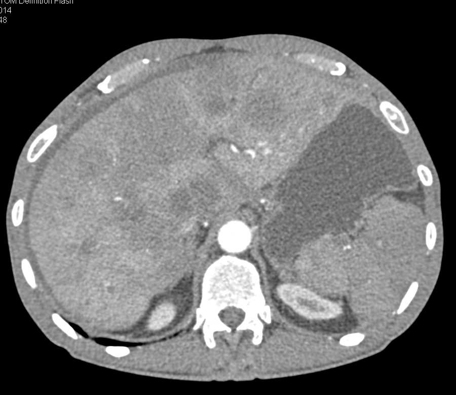 Carcinoma Tail of the Pancreas Invades the Spleen and Left Kidney - CTisus CT Scan