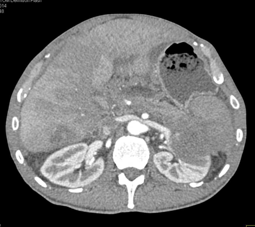 Carcinoma of Tail of Pancreas Invades the Left Kidney - CTisus CT Scan