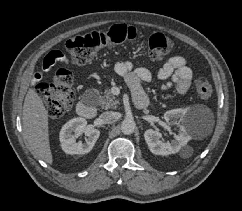 Choledochal Cyst Simulates a Pancreatic Cyst - CTisus CT Scan