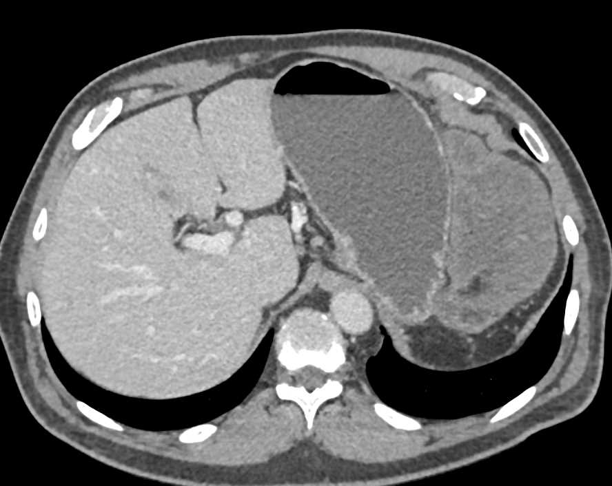 Omental Infarction s/p Distal Pancreatectomy and Splenectomy - CTisus CT Scan