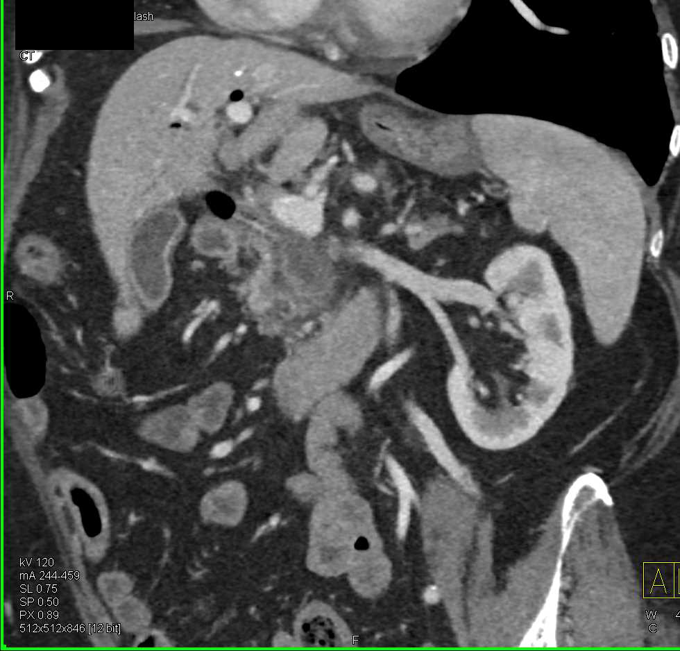 Pancreatic Adenocarcinoma Obstructs the Pancreatic Duct - CTisus CT Scan