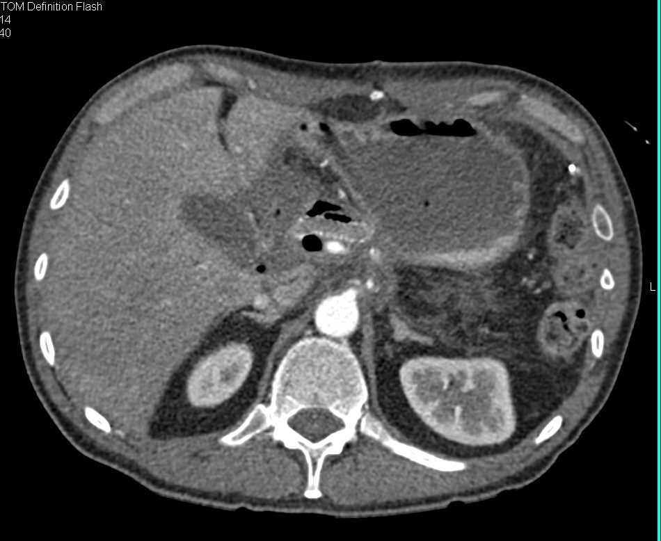 Inflammation Pancreatic Bed s/p Pancreatic Surgery - CTisus CT Scan