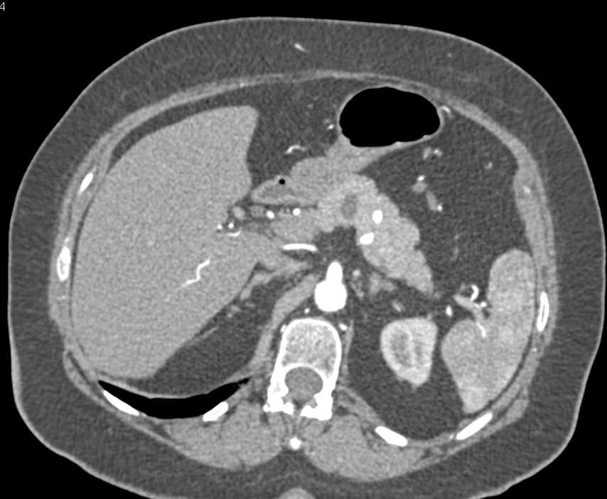 Intraductal Papillary Mucinous Neoplasm (IPMN) Body of Pancreas - CTisus CT Scan