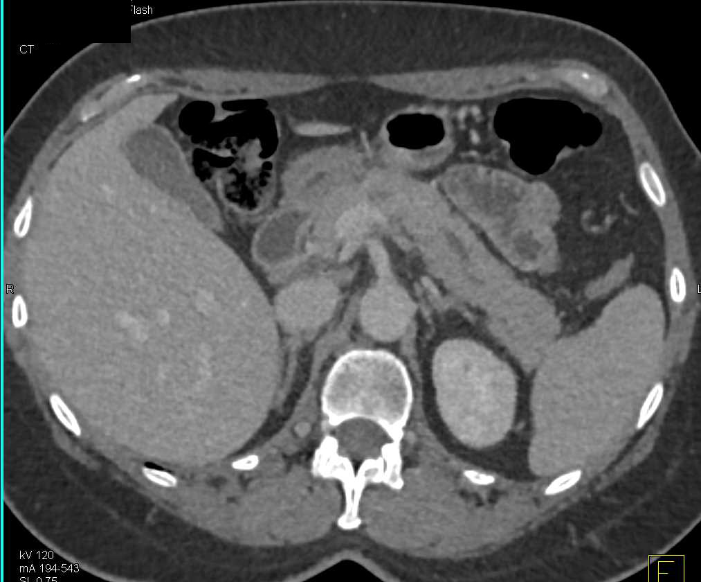 Subtle Carcinoma of the Body of the Pancreas with Dilated Pancreatic Duct - CTisus CT Scan