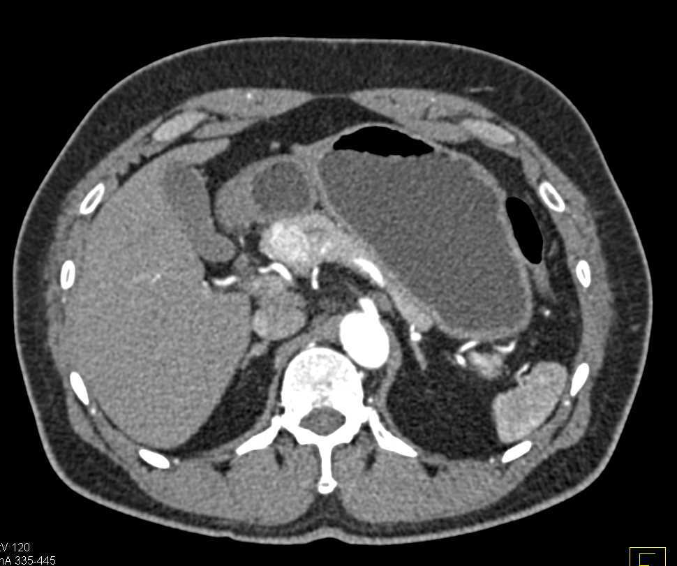 Renal Cell Carcinoma Metastatic to the Head of the Pancreas - CTisus CT Scan