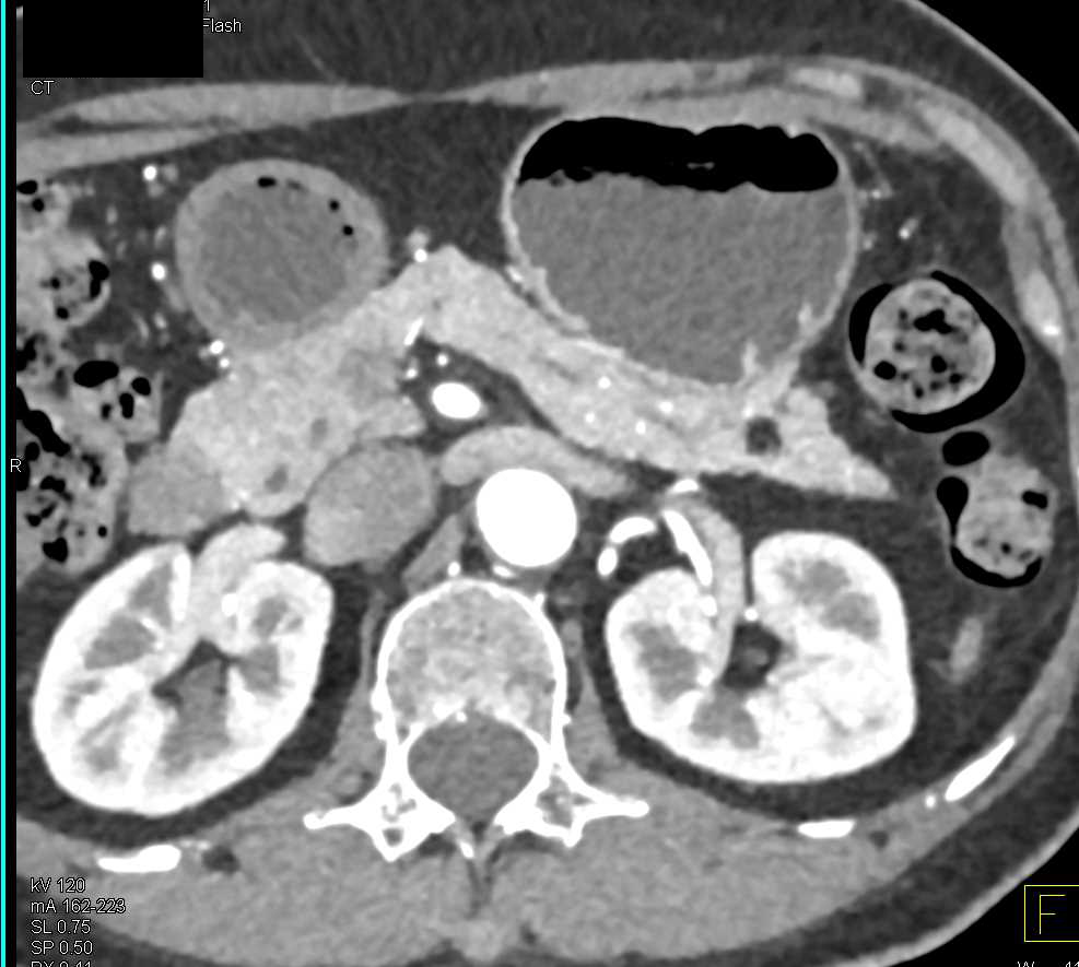 Incidental Lipoma in Tail of the Pancreas - CTisus CT Scan