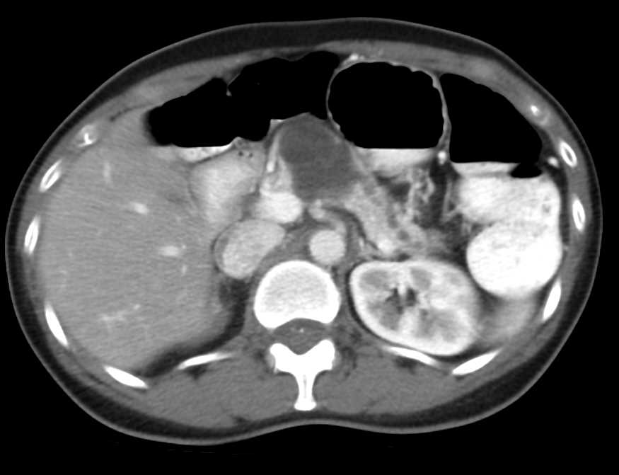 Main Duct Intraductal Papillary Mucinous Neoplasm (IPMN) - CTisus CT Scan