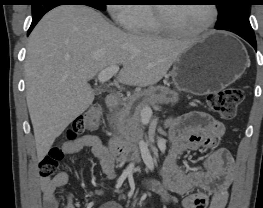 Central Intraductal Papillary Mucinous Neoplasm (IPMN) - CTisus CT Scan