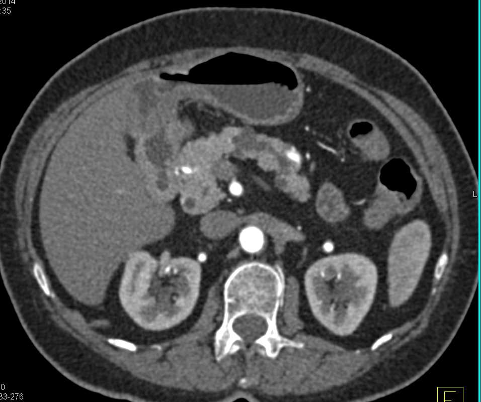 Main Duct Intraductal Papillary Mucinous Neoplasm (IPMN) - CTisus CT Scan