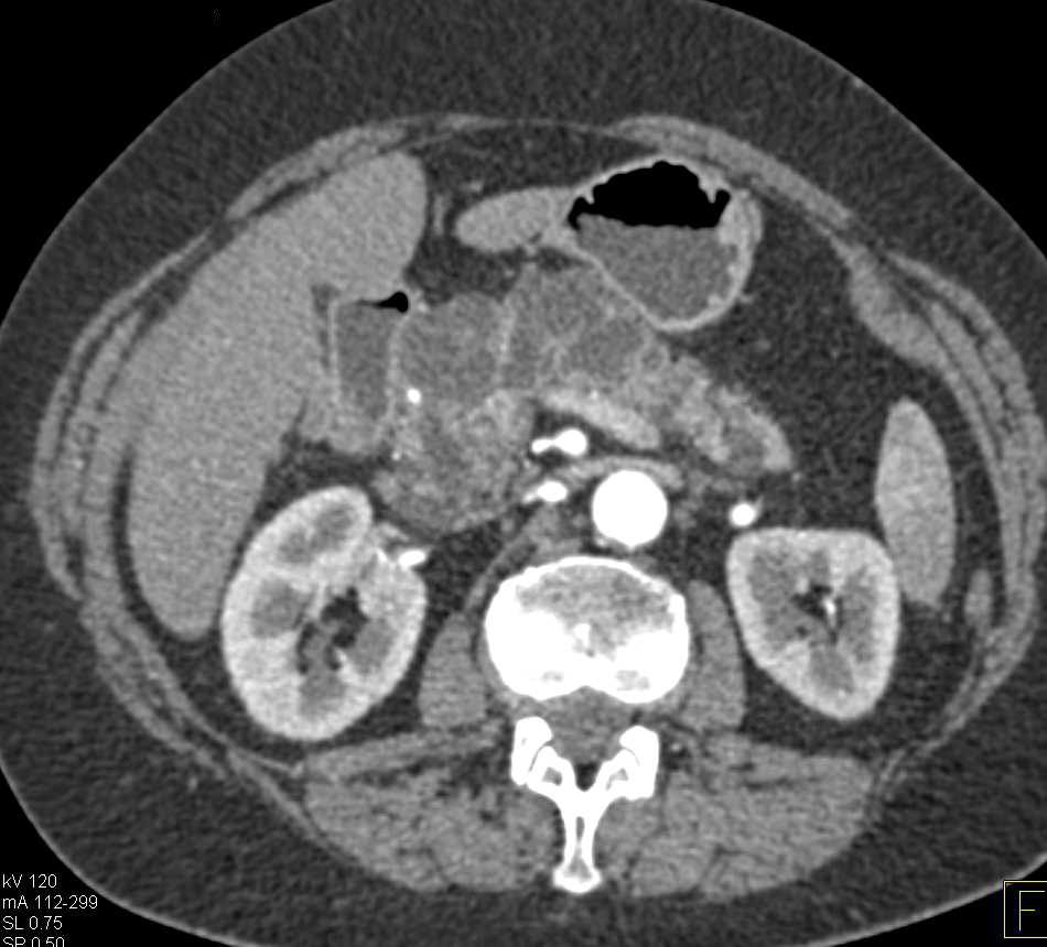 Multiple Intraductal Papillary Mucinous Neoplasms (IPMNs) in the Pancreas - CTisus CT Scan