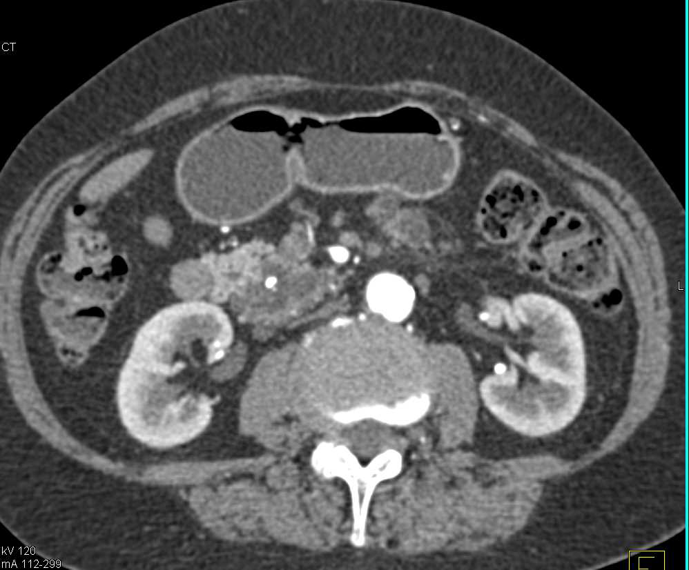 Multiple Intraductal Papillary Mucinous Neoplasms (IPMNs) in the Pancreas - CTisus CT Scan