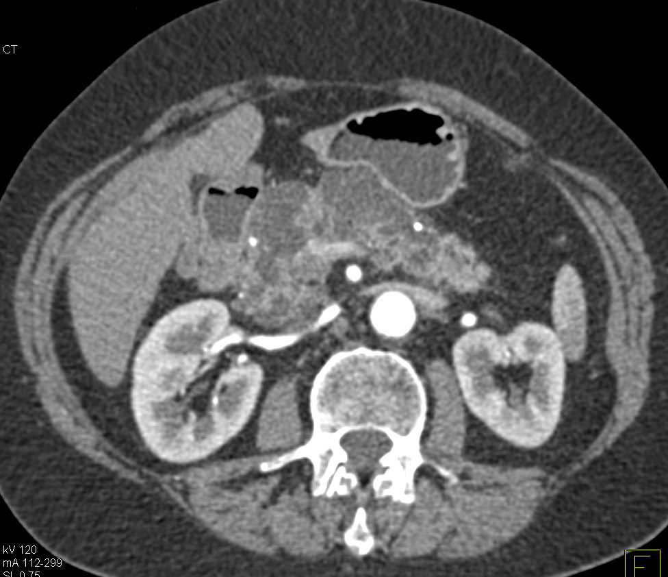 Multiple Intraductal Papillary Mucinous Neoplasms (IPMNs) with Suspicious Lesion in the Head of the Pancreas - CTisus CT Scan